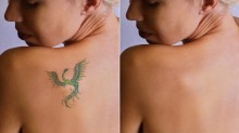 Vous souhaitez enlever un tatouage sans cicatrice au laser proche d’Issy les moulineaux  Suresnes  Docteur Hosana 